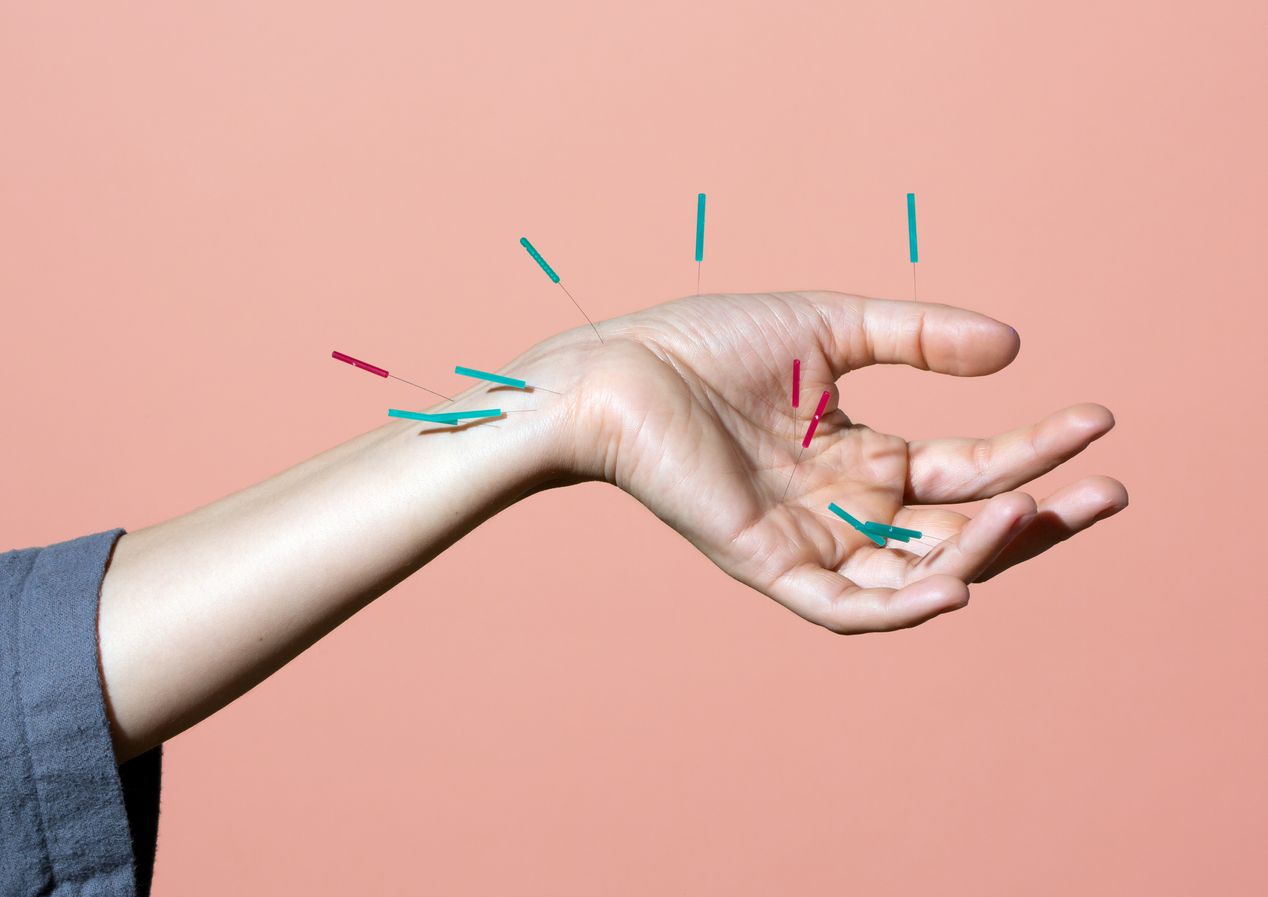Hand with acupuncture needles, editorial photography, Ilona Szwarc, Los Angeles.